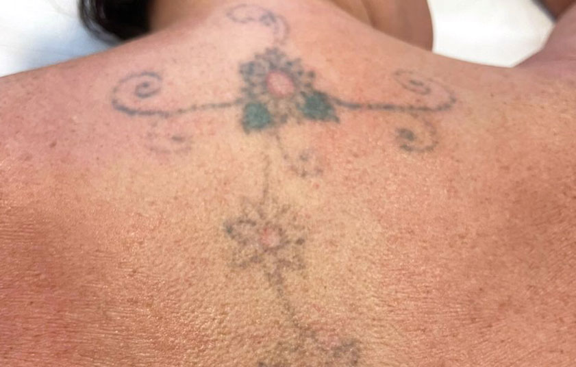 Lexington ranks 2nd nationally for tattoo removal