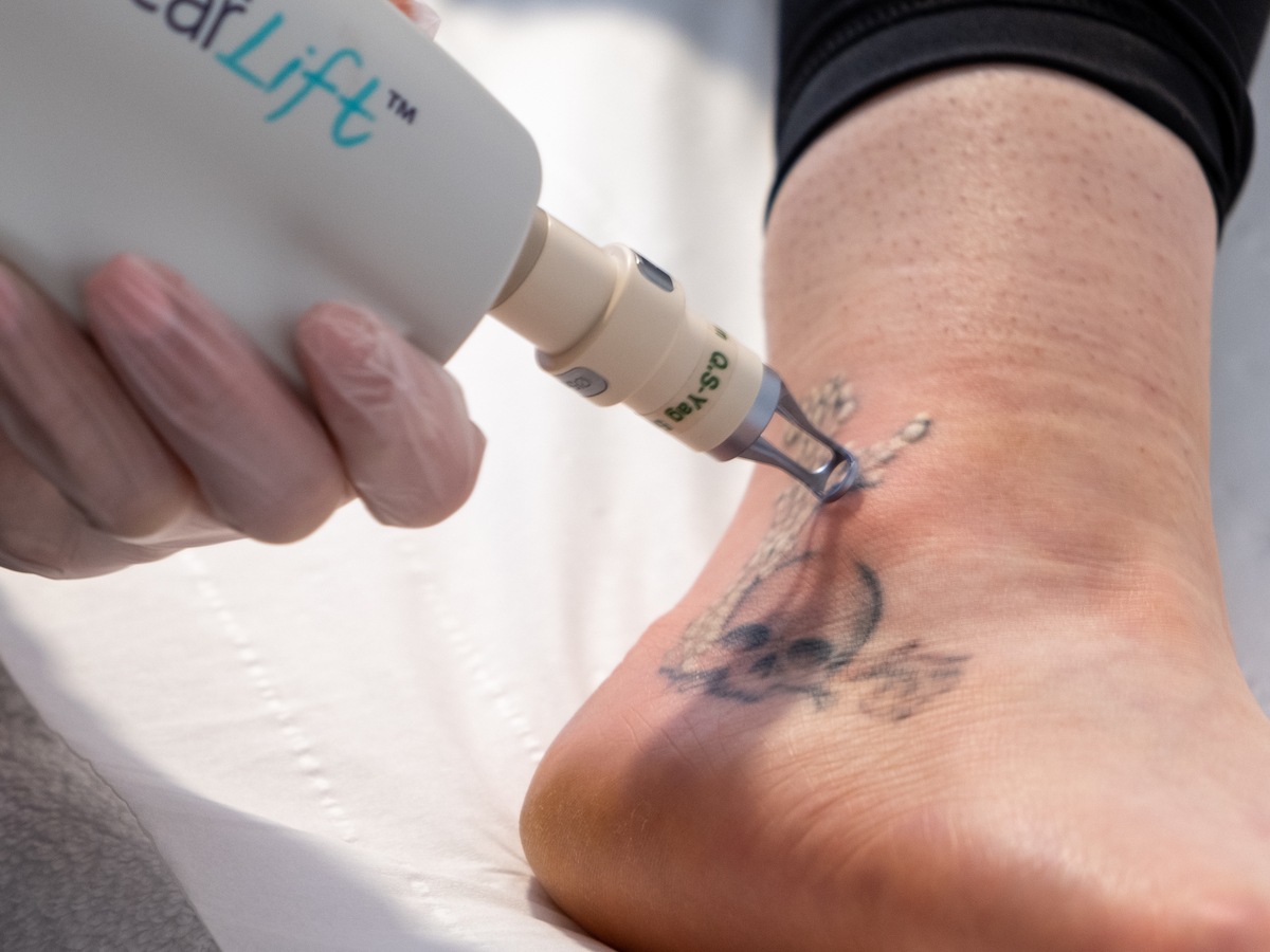 Tattoo Removal Perth | Laser Tattoo Removal - Medaesthetics